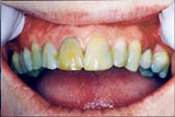 Before and After CEREC