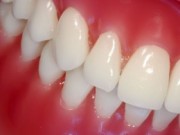 Picture of periodontal disease before treatment.