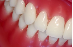 Picture of healthy gums and teeth to demonstrate the difference between bleeding gums and healthy gums.