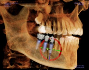 Oral CT Scan with ConeBeam