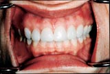 No Gapes after CEREC