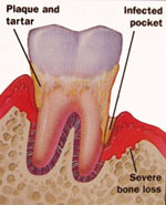 Picture of a tooth and bone loss at the base of the tooth.