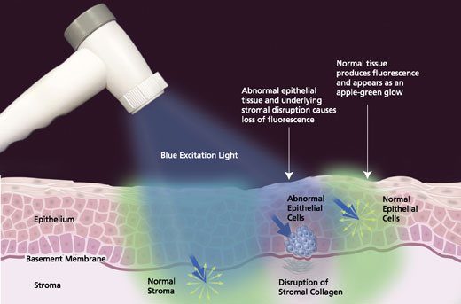 The Velscope system