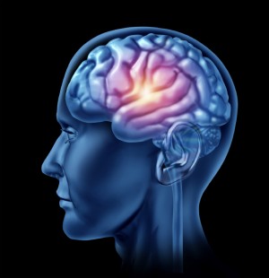 Pic of a human brain that demonstrates a stroke.