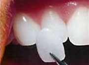 Picture showing how veneers can change the color of teeth.