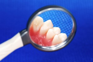 Picture of gum disease and plaque being taken off of teeth with a dental pick. 