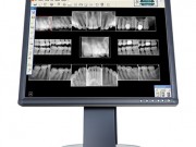 Pictures of digital xrays on a computer screen 