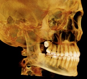 Precise 3d model of skull showing decay