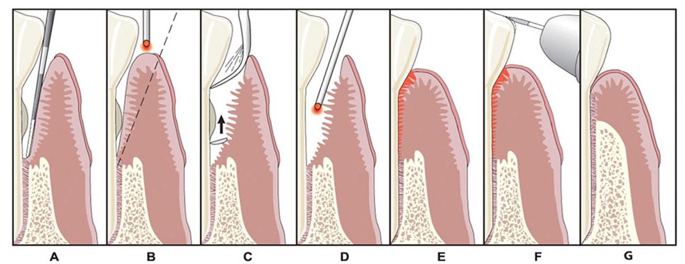 Picture is a step by step illustration of the LANAP gum disease surgery.