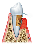 Pic of advanced periodontal disease and receding gums.
