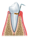 Pic of bleeding sore gums with gingivitis.