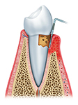 Pic of periodontitis and bleeding gums.