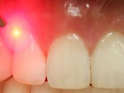 Picture of the LANAP Periolase laser gum surgery being performed on gums