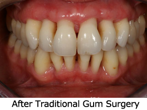 Picture is an illustration of lanap gum surgery versus traditional gum surgery that uses a blade.